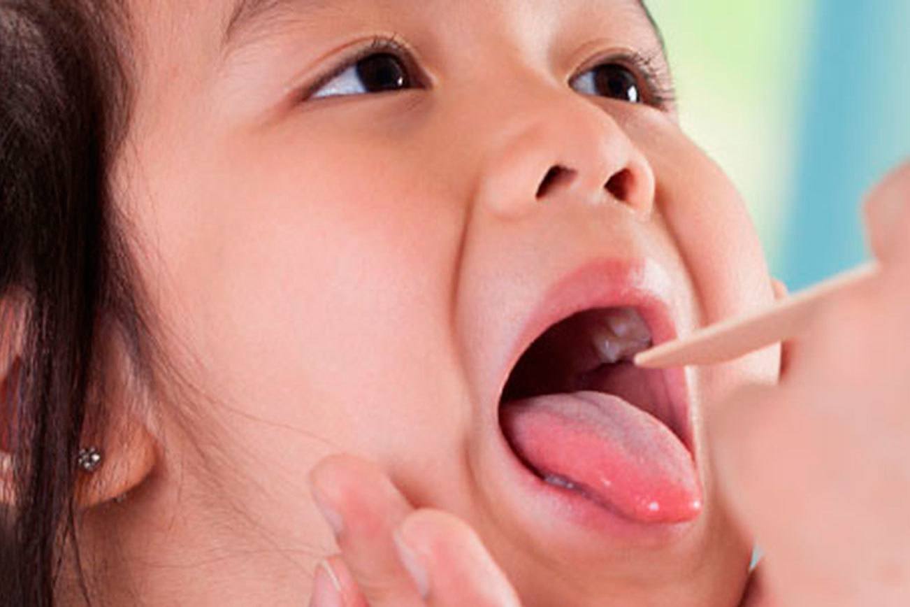 54 mumps cases have been reported in King County